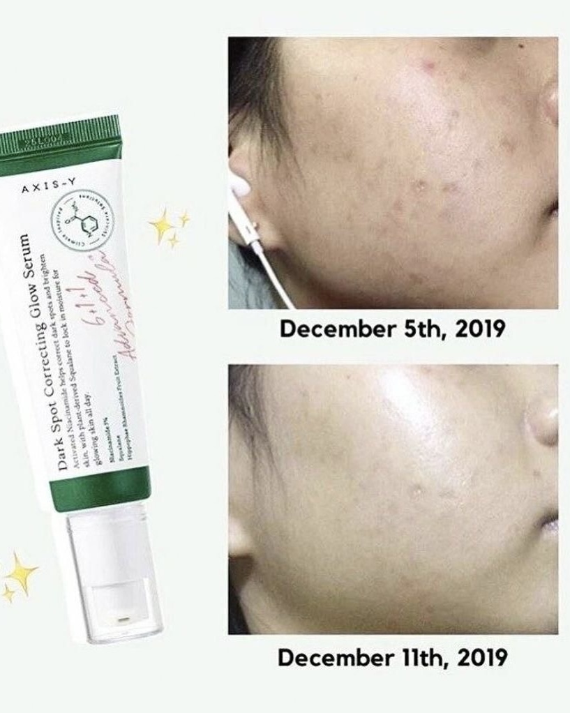 درمان جوش های فعال و لک های تازه با سرم اکسیس وای