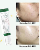 درمان جوش های فعال و لک های تازه با سرم اکسیس وای