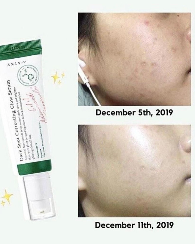 درمان جوش های فعال و لک های تازه با سرم اکسیس وای